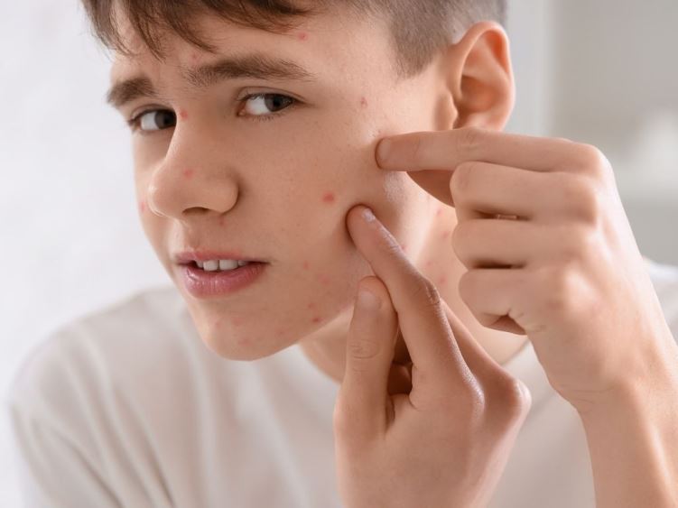 Як лікувати акне у підлітка