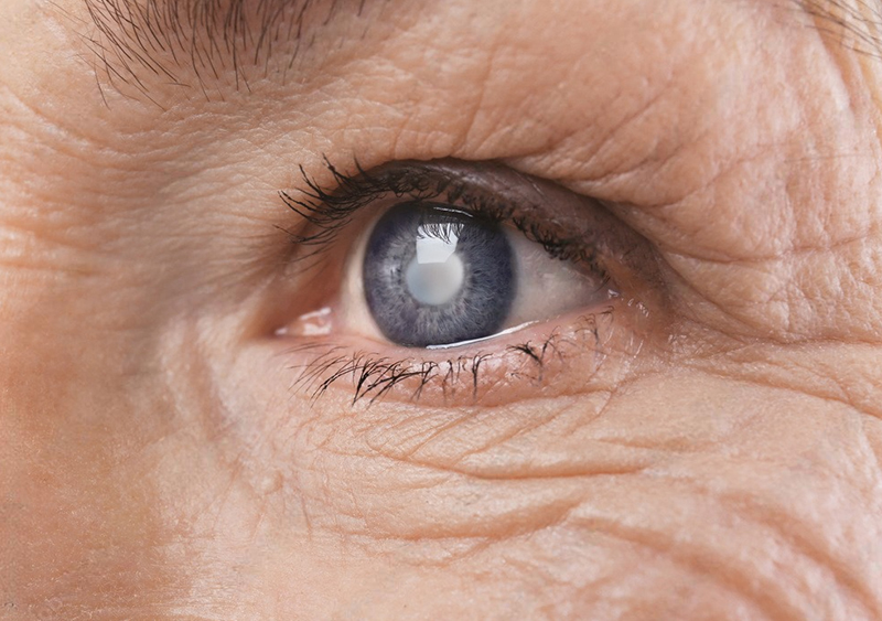 Лікування катаракти у Medibor: досвід та професіоналізм
