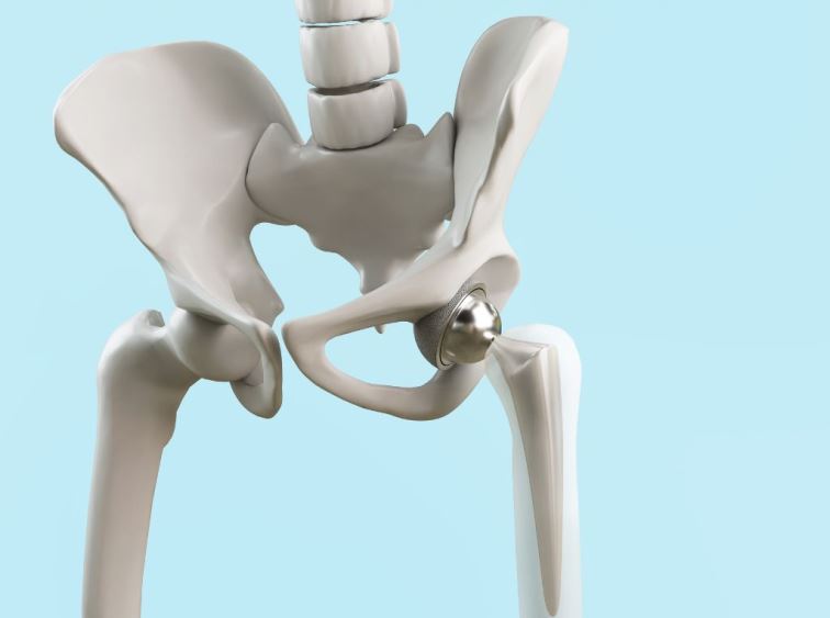 Ендопротезування кульшового суглоба: коли настав час повернути свободу руху