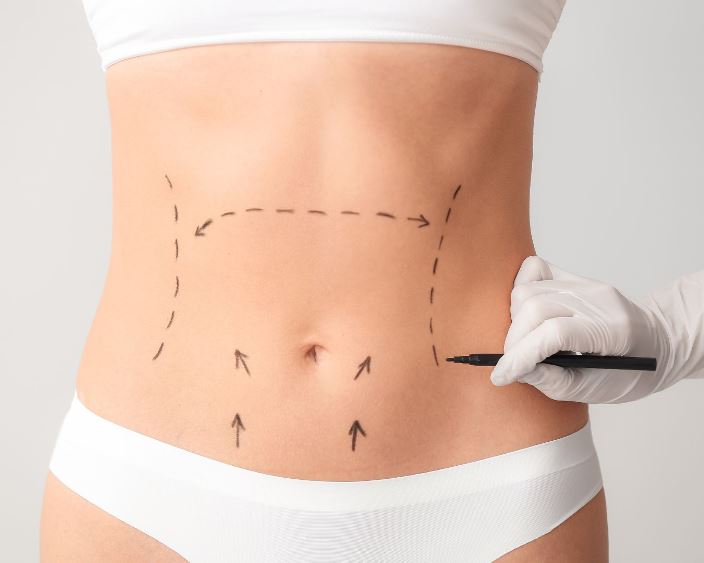 Плоский живіт без компромісів: сучасна абдомінопластика в Medibor