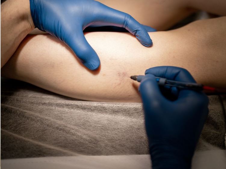 Склеротерапія Житомир