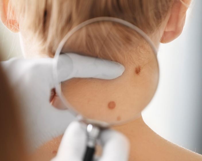 Дерматоскопія: чому обстеження шкіри необхідне навіть взимку