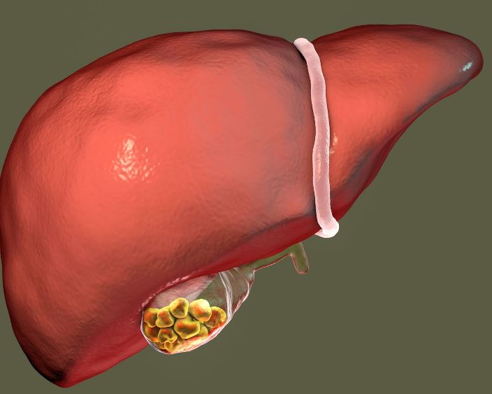 Жовчокам’яна хвороба: коли камені мовчать, а коли сигналять про небезпеку