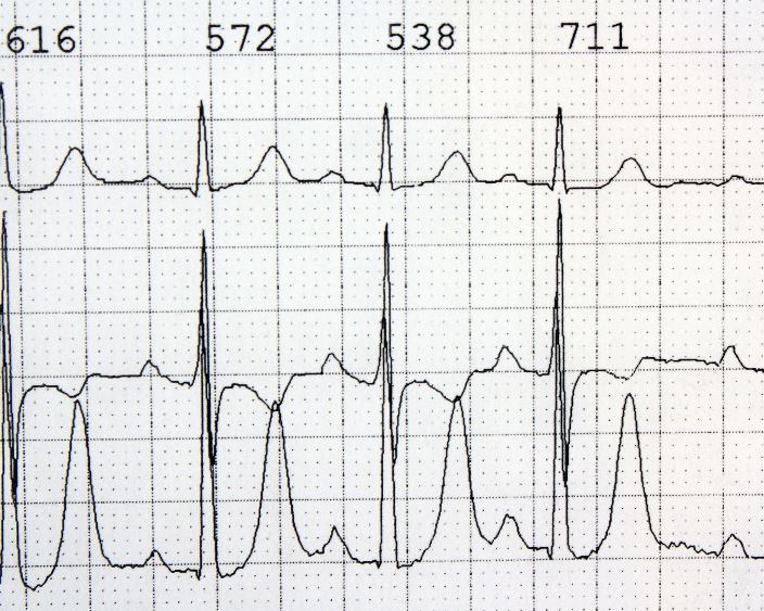 Чому варто зробити кардіограму навіть без скарг?