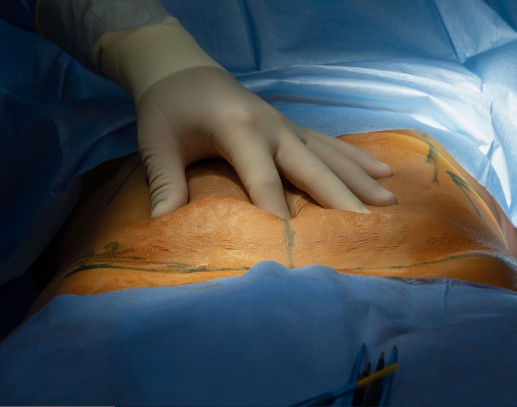 Пластика живота Житомир