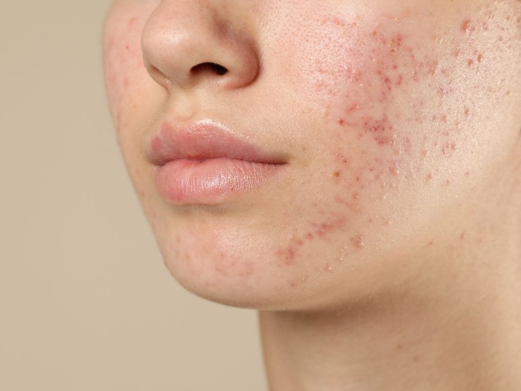 Як лікувати акне у підлітка