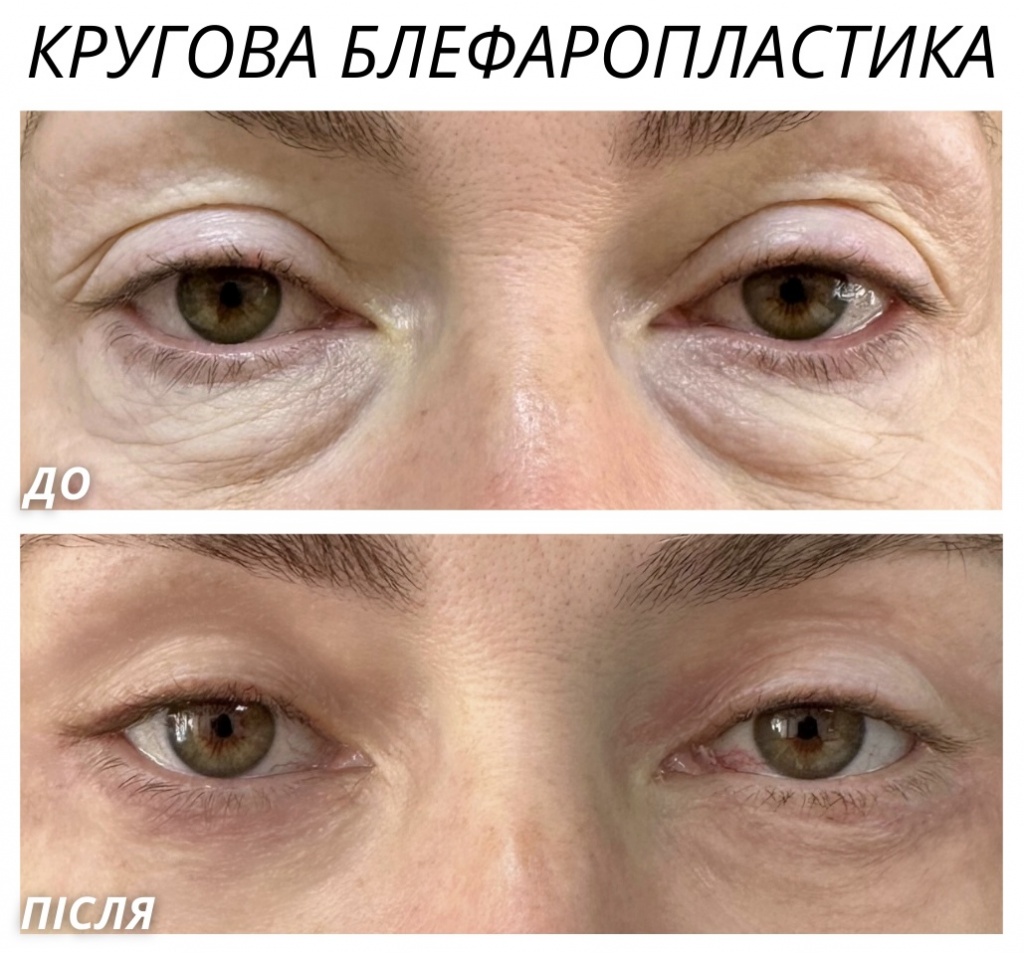 Кругова блефаропластика Кругова блефаропластика