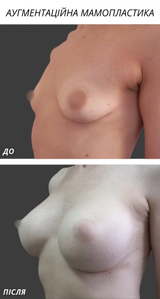 Аугментаційна мамопластика