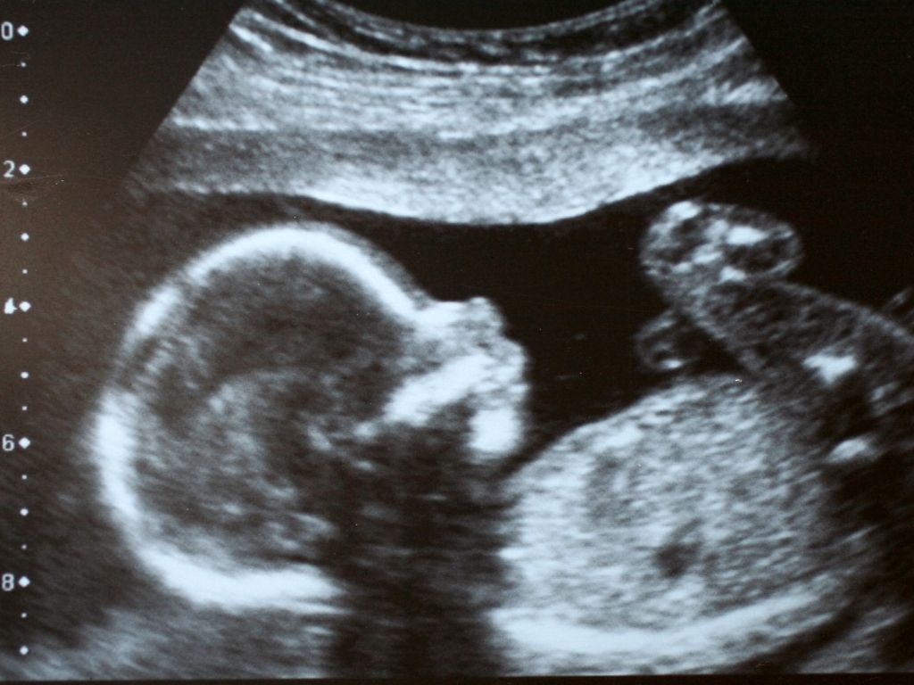УЗД вагітності
