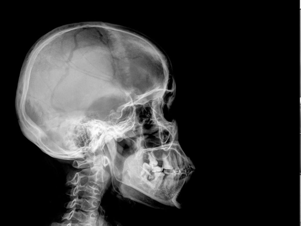 Рентген кісток черепа