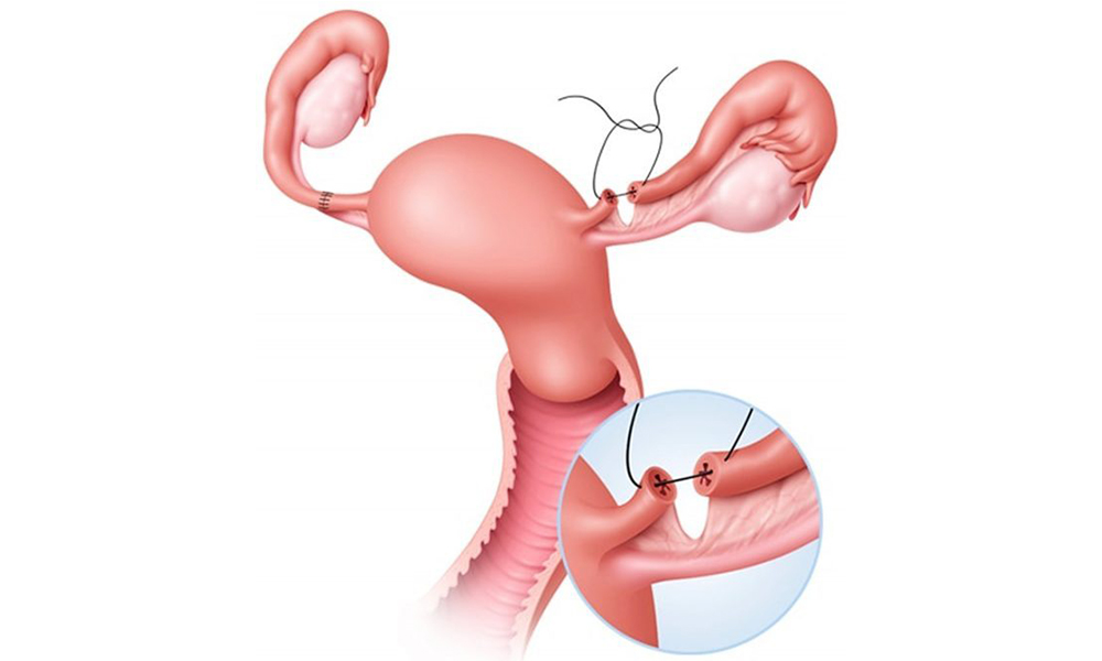 Хірургічна контрацепція Житомир