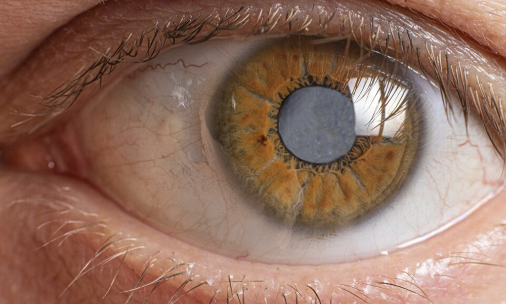 Лікування катаракти Житомир