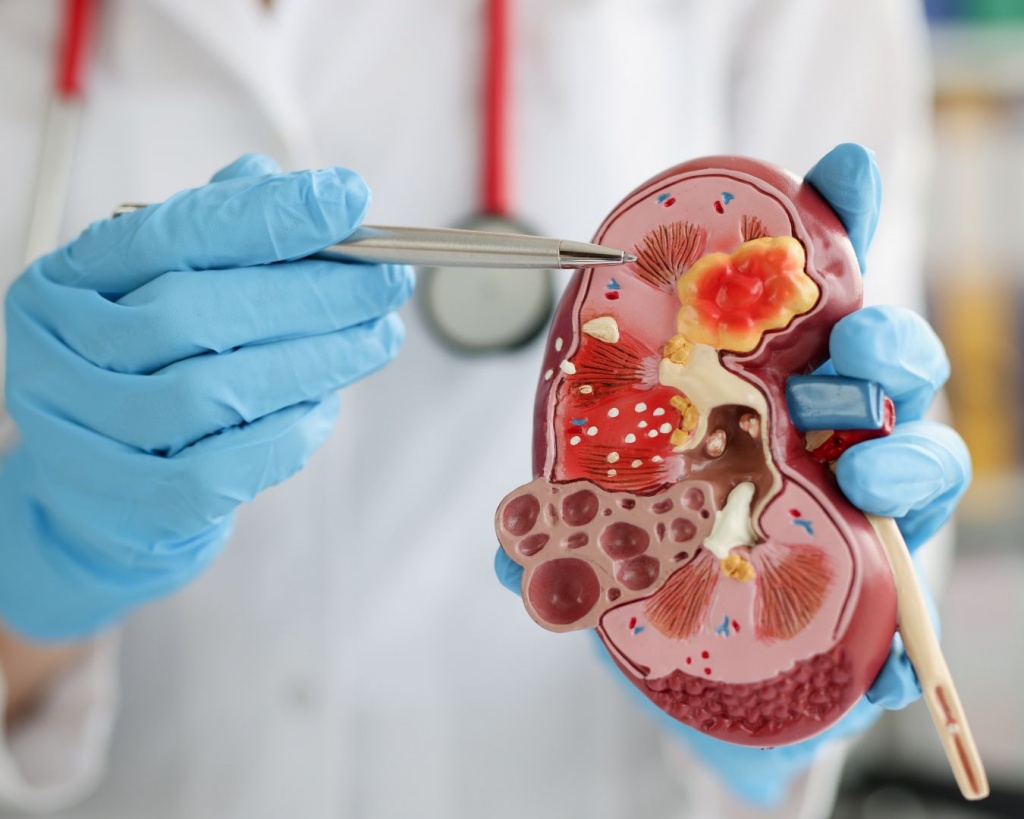 Перкутанна літотрипсія