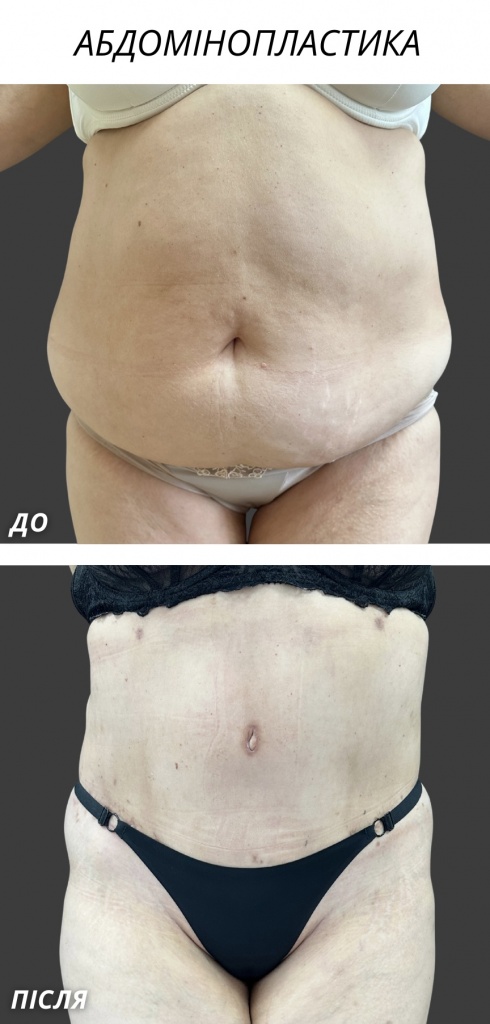 Абдомінопластика