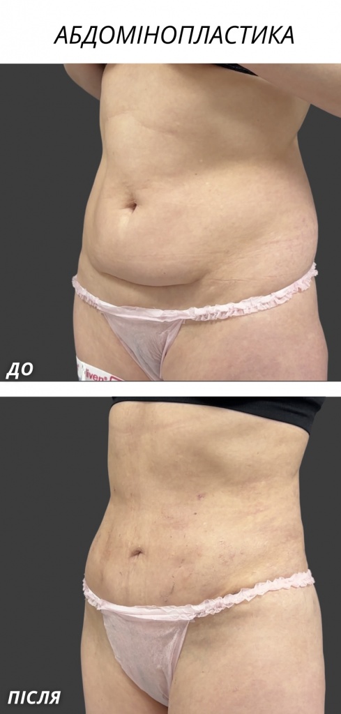 Абдомінопластика