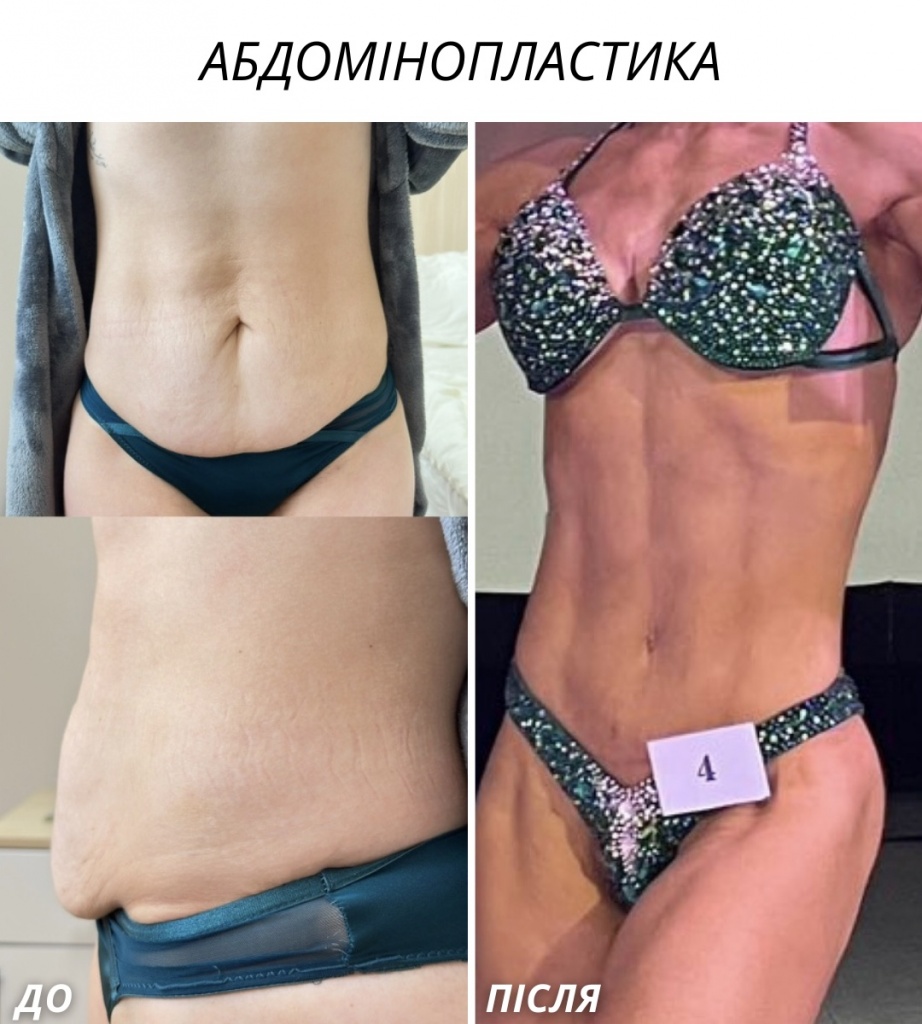 Абдомінопластика