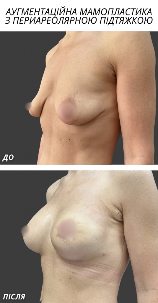 Аугментаційна мамопластика