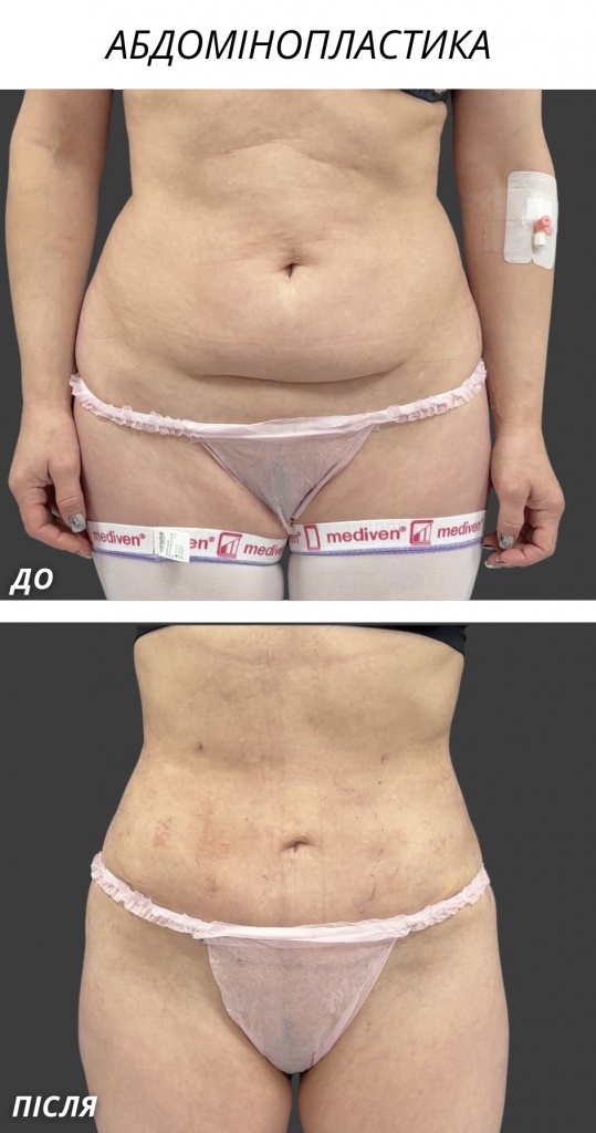 Абдомінопластика