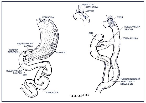 Схема виконаної операції Видалення шлунку та з'єднання стравоходу з тонким кишківником
