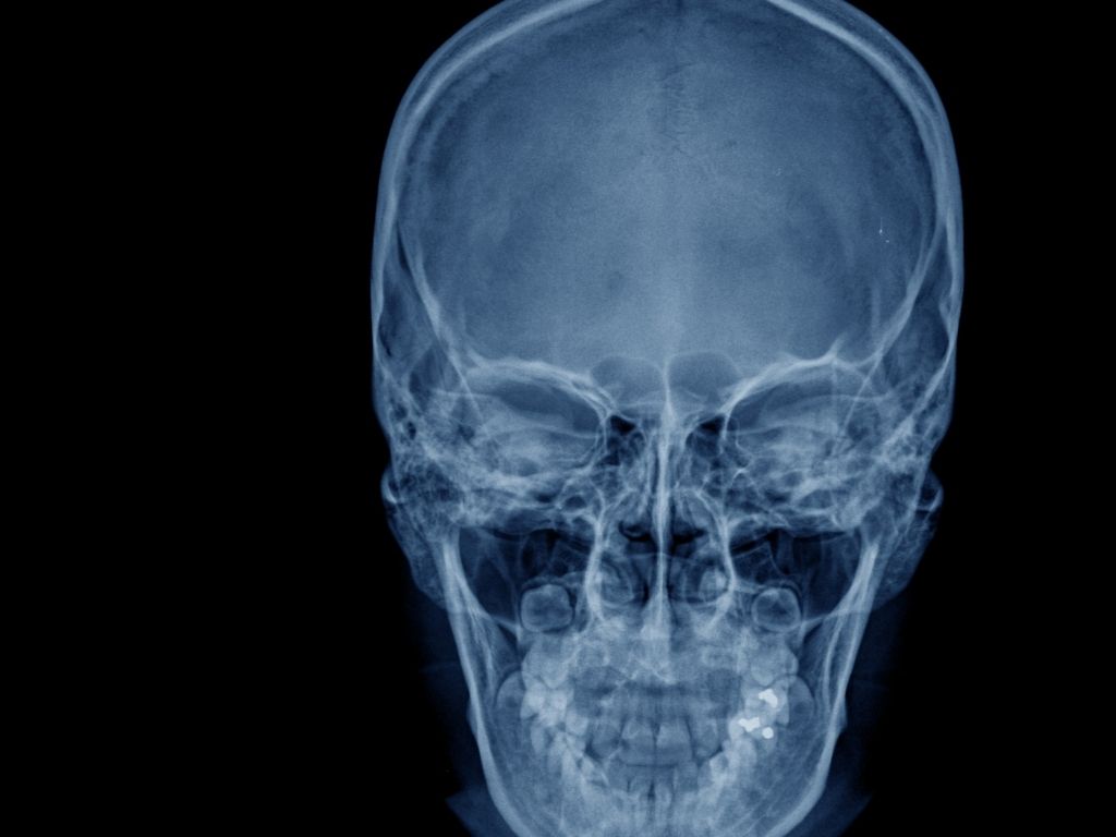 Рентген кісток носа