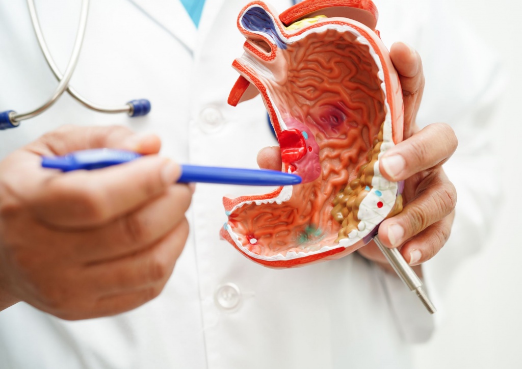 Лікування виразки шлунка