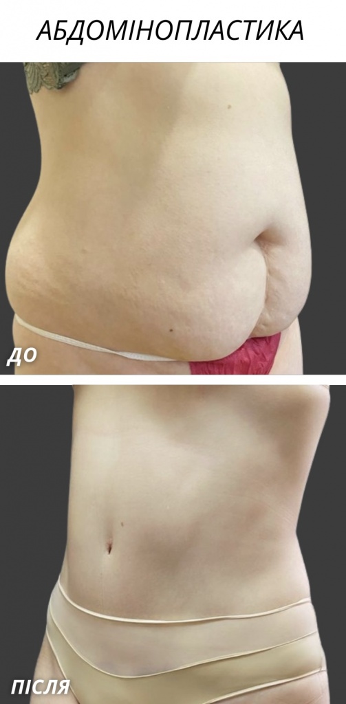 Абдомінопластика