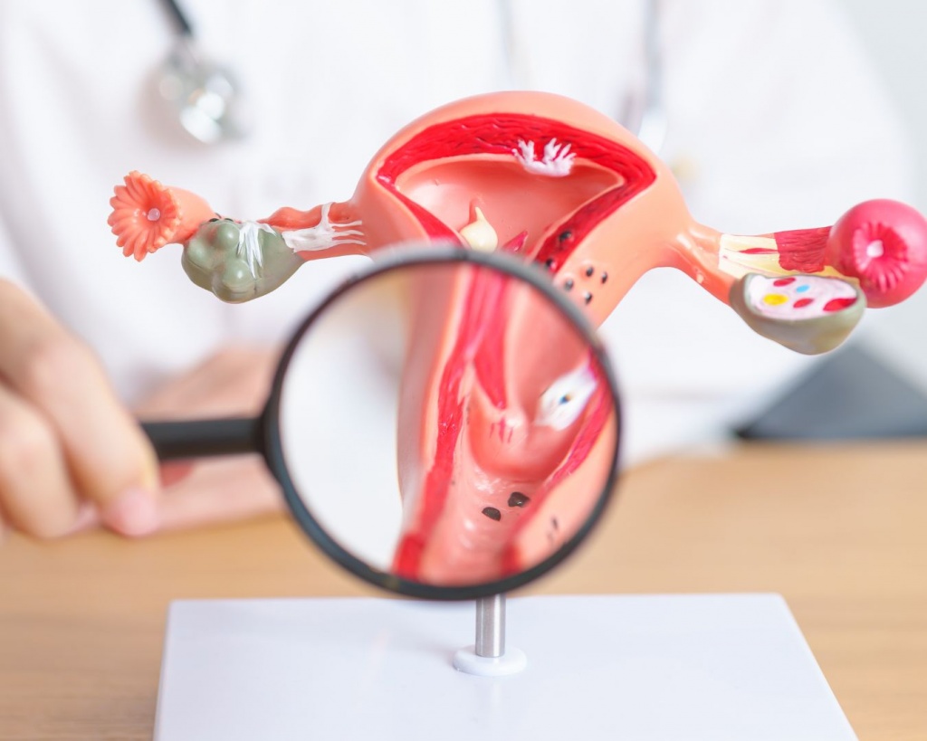 Лікування ендометріозу