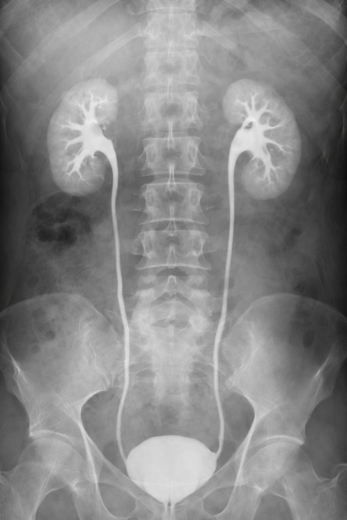 Рентген нирок та сечовивідних шляхів