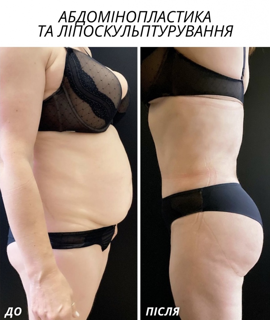 Абдомінопластика