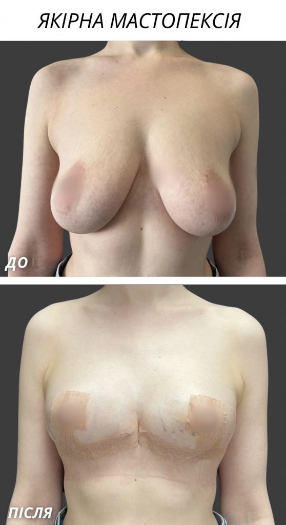 Якірна мамопластика