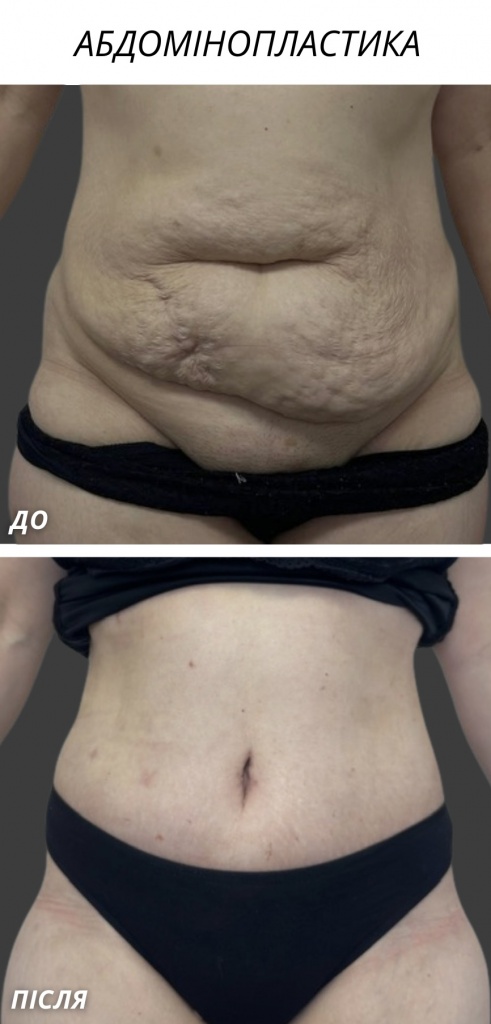 Абдомінопластика