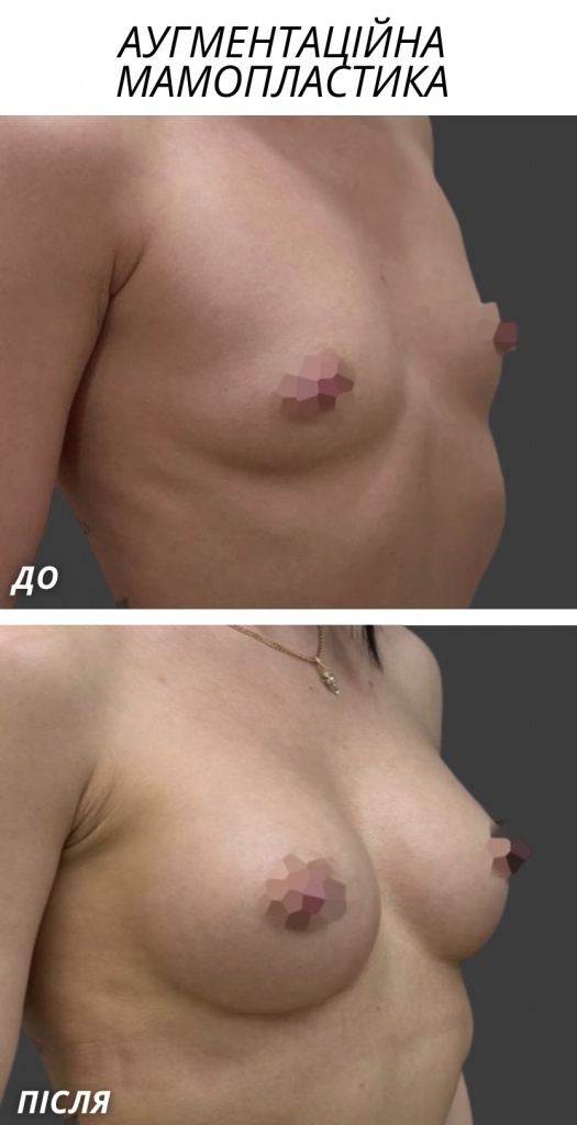 аугментаційна мамопластика