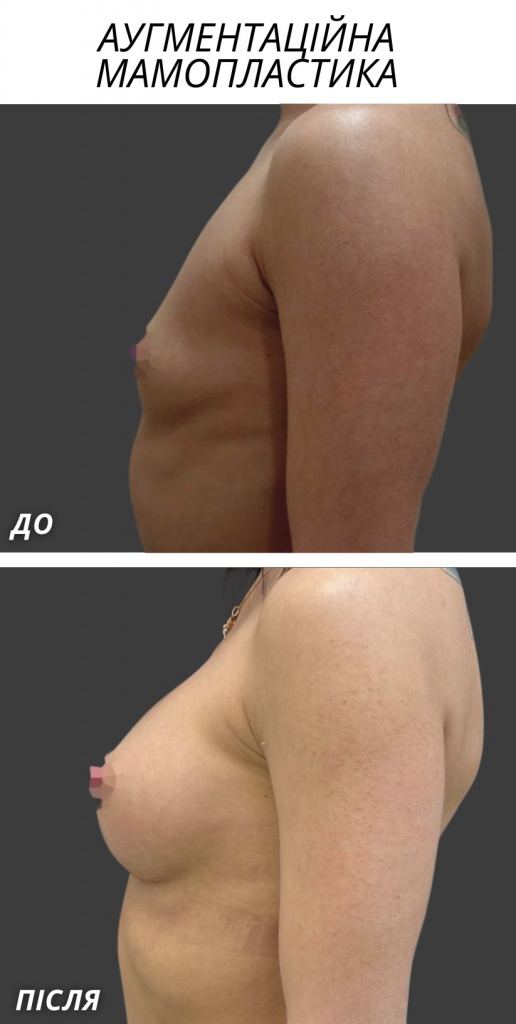 аугментаційна мамопластика