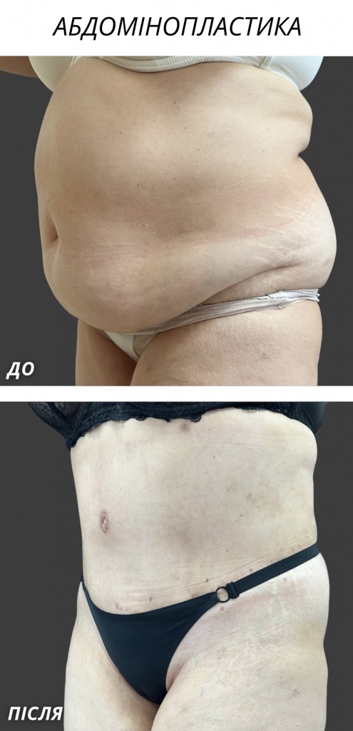 Абдомінопластика