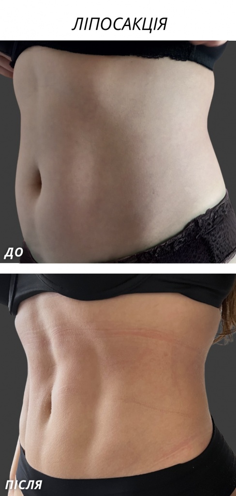 ліпосакція