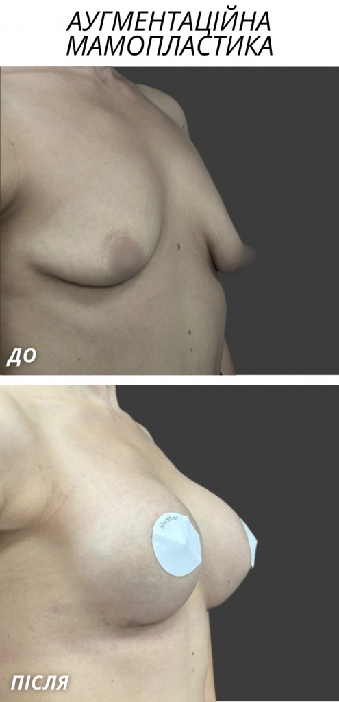 аугментаційна мамопластика