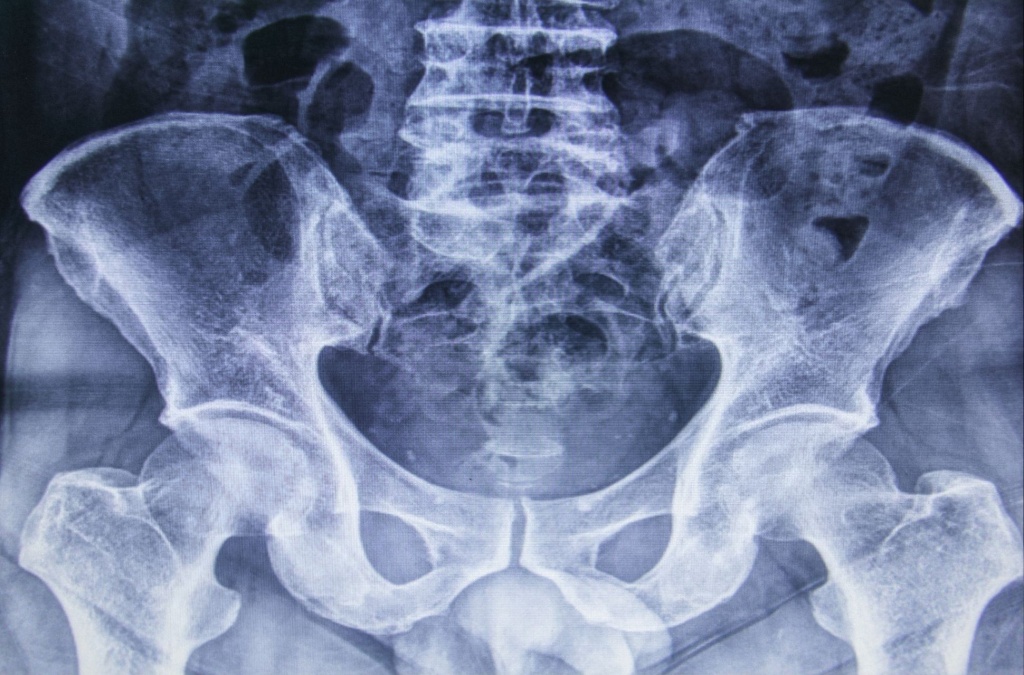 Рентген тазу