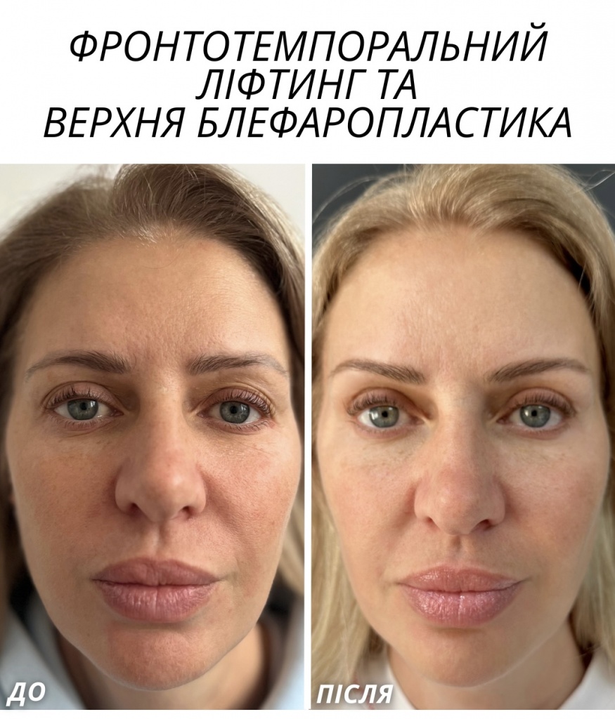 фронтотемпоральний ліфтинг та верхня блефаропластика фронтотемпоральний ліфтинг та верхня блефаропластика