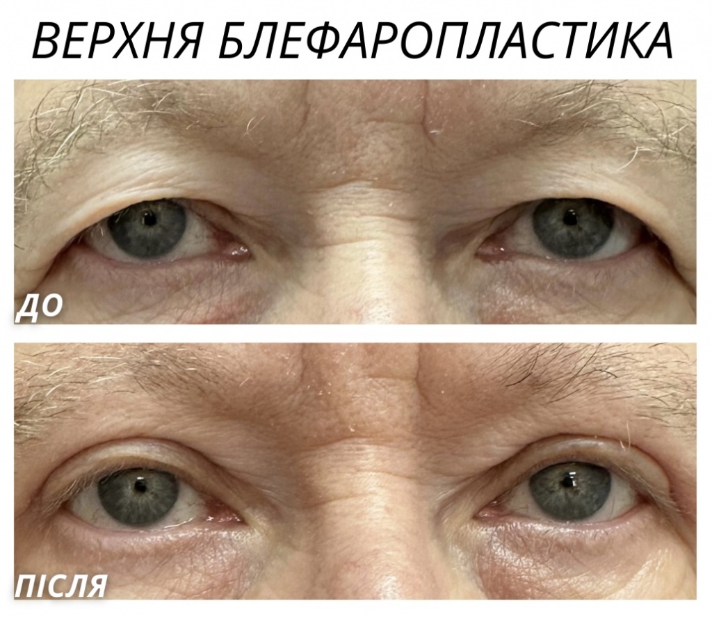 Верхня блефаропластика Верхня блефаропластика