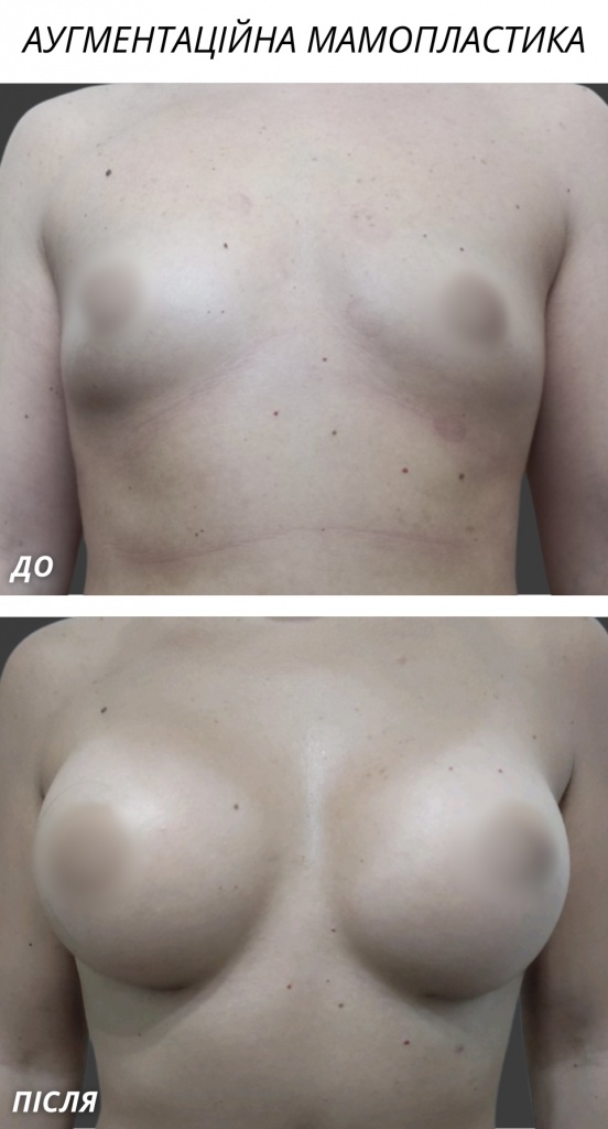 Аугментаційна мамопластика