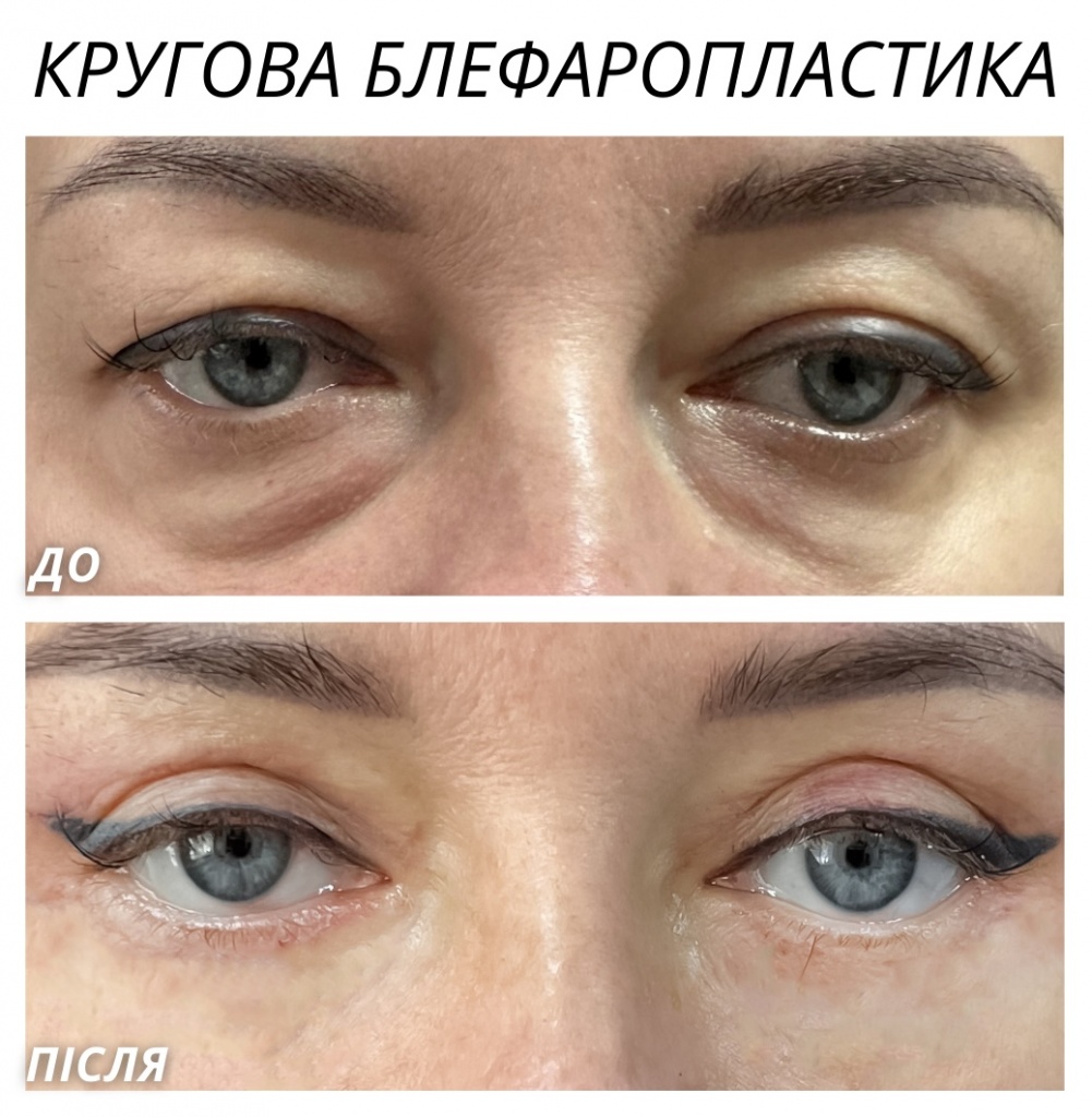 Кругова блефаропластика Кругова блефаропластика