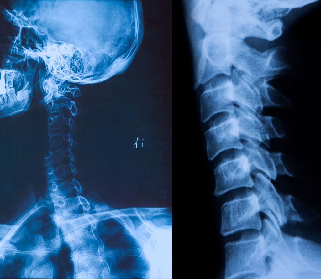 Рентген шиї