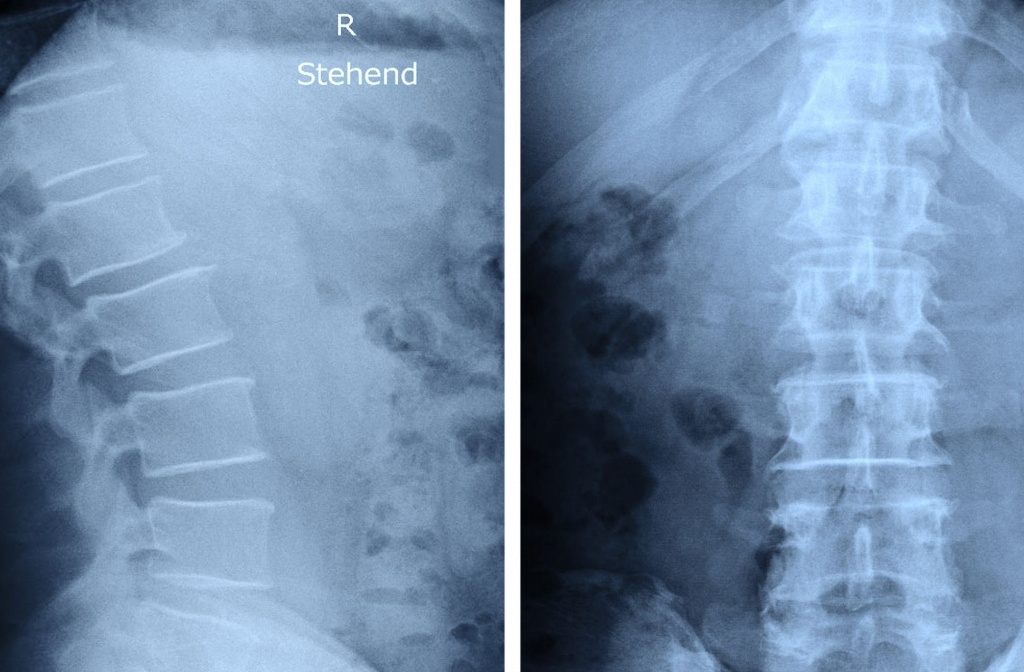 Рентген попереку
