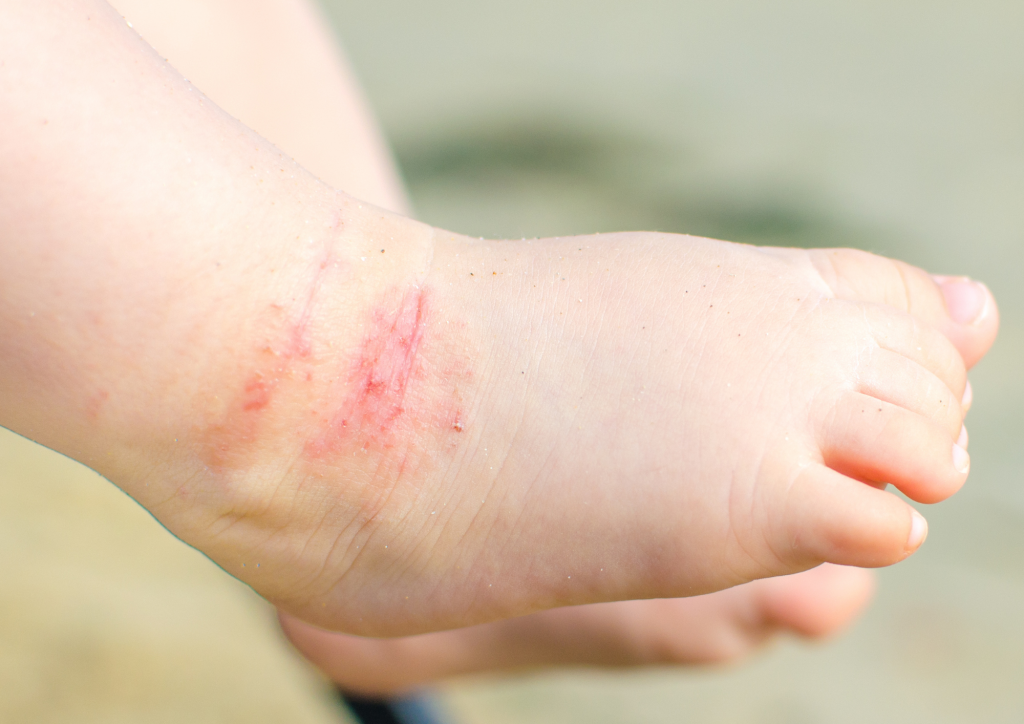 Атопічний дерматит у дитини