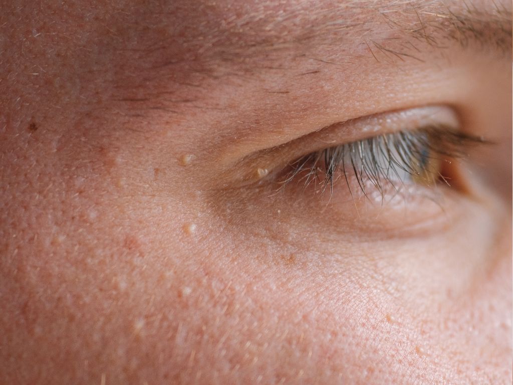 Что такое ксантелазма