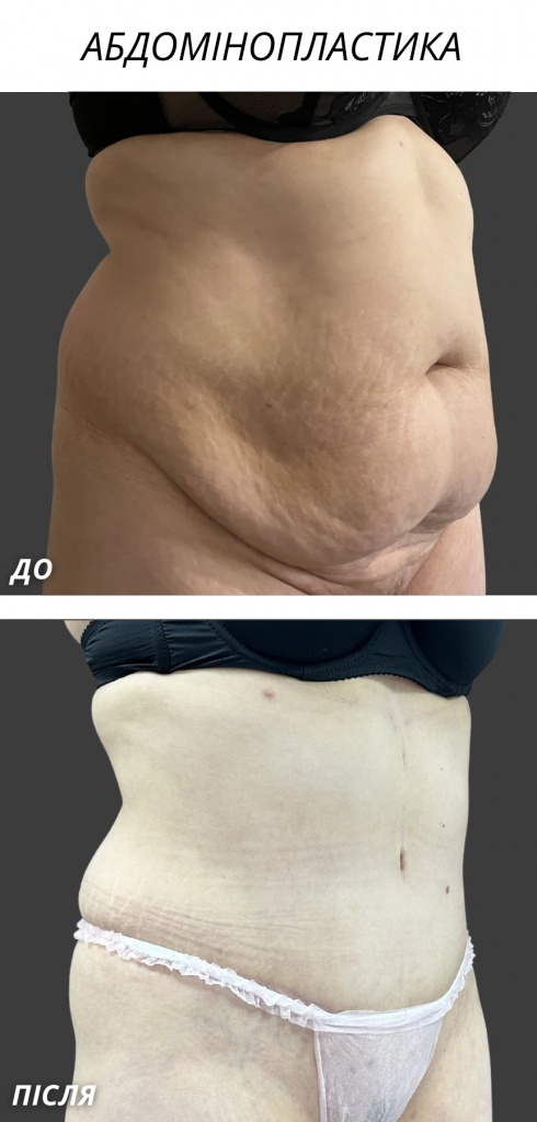 Абдомінопластика