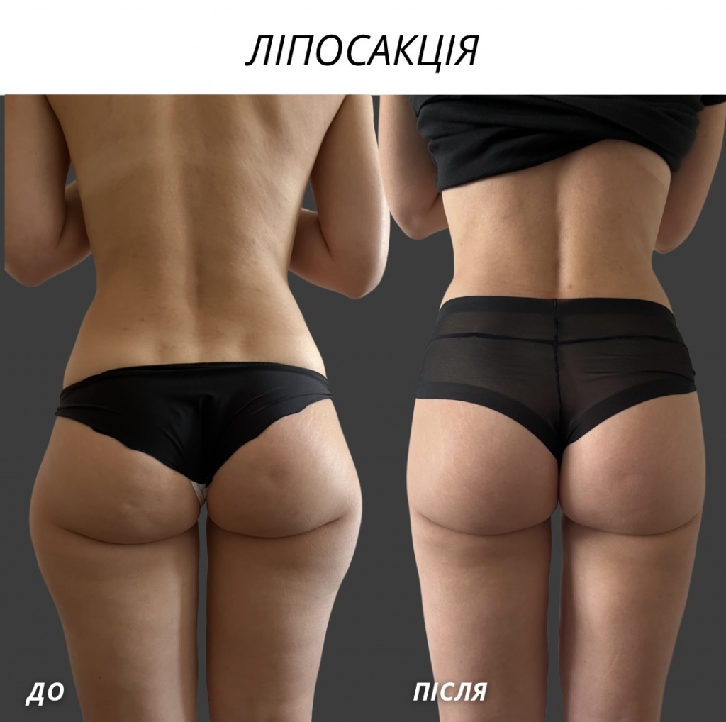ліпосакція