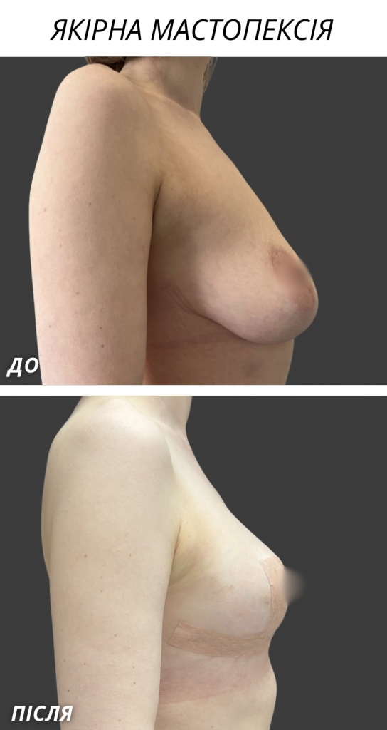 Якірна мамопластика