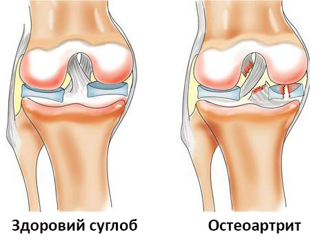 Лікування остеоартриту в Медібор
