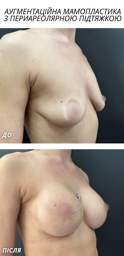 Аугментаційна мамопластика